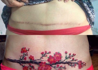 Xăm che sẹo, che dạn, khuyết điểm..