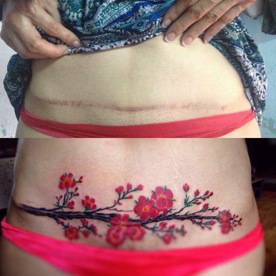 Xăm che sẹo, che dạn, khuyết điểm..